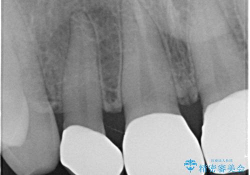 前歯の隙間を埋めたい 矯正かクラウンかの治療中