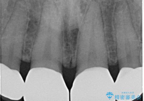 前歯の隙間を埋めたい 矯正かクラウンかの治療後