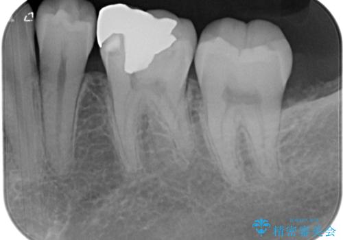 銀歯のところがしみる オールセラミッククラウンの治療前