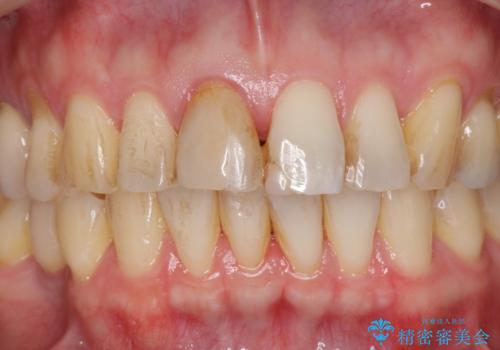 前歯の変色を改善 オールセラミック治療の治療前