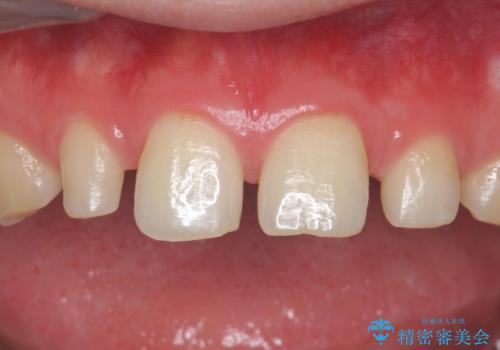 前歯の隙間を埋めたい 矯正かクラウンかの治療前