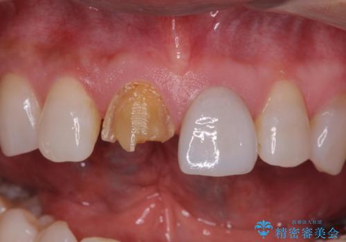ラミネートべニアが取れた ジルコニアクラウンでの修復の治療前