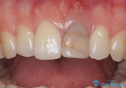 前歯が暗く変色 ジルコニアクラウンでの修復の治療前