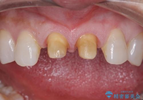 ラミネートべニアが取れた ジルコニアクラウンでの修復の治療中