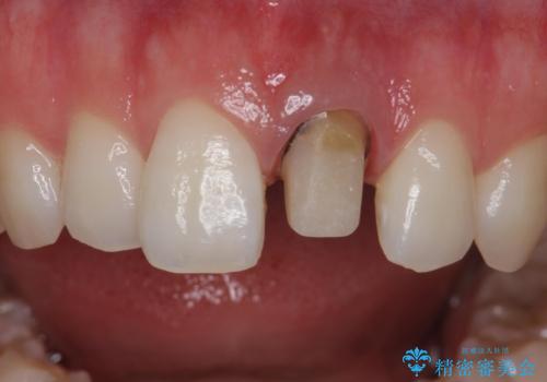 前歯が暗く変色 ジルコニアクラウンでの修復の治療中