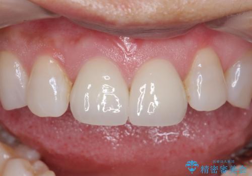 ラミネートべニアが取れた ジルコニアクラウンでの修復の治療後