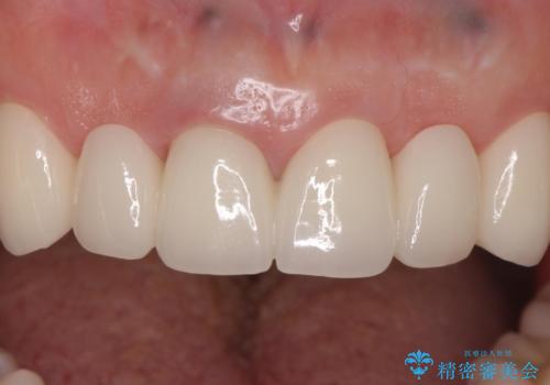 入れ歯を変えたい ブリッジでの修復治療の症例 治療後