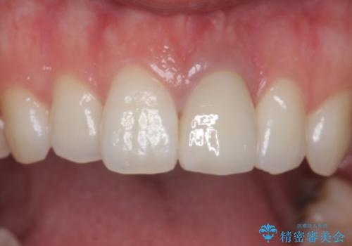 前歯が暗く変色 ジルコニアクラウンでの修復の治療後