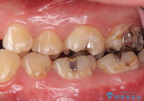 奥の虫歯 ジルコニアクラウンでの修復の治療前