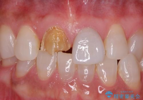 ラミネートべニアが取れた ジルコニアクラウンでの修復