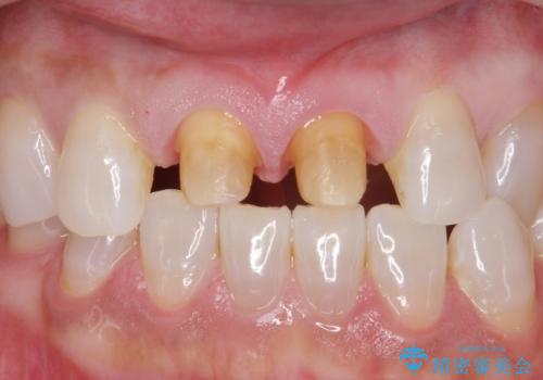 ラミネートべニアが取れた ジルコニアクラウンでの修復の治療中