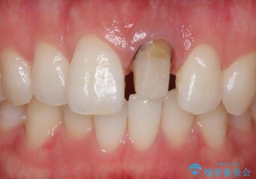 前歯が暗く変色 ジルコニアクラウンでの修復の治療中