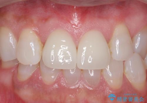ラミネートべニアが取れた ジルコニアクラウンでの修復の症例 治療後