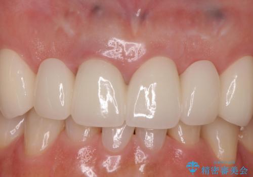 入れ歯を変えたい ブリッジでの修復治療の治療後