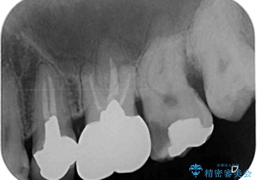 銀歯をなくしたい 全顎的なむし歯治療の治療前