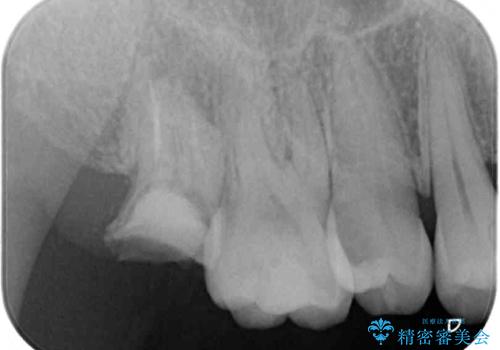 放置したむし歯　抜歯後にインプラントで補綴治療の治療前