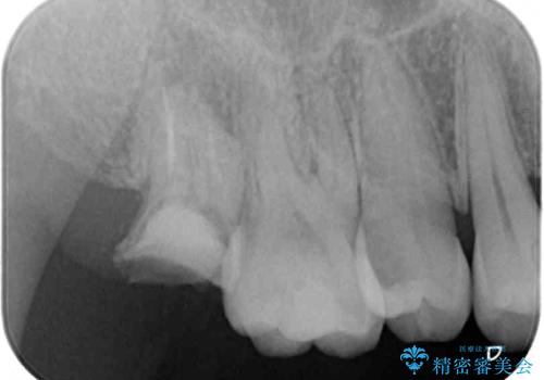 放置したむし歯 抜歯後にインプラントで補綴治療の治療前