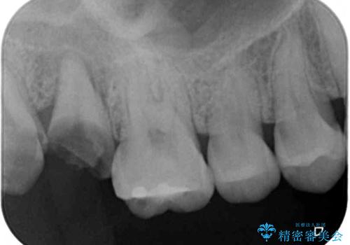 歯医者が怖い 1DAYインプラントで外科処置の恐怖を軽減の治療前