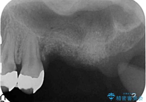 虫歯・破折の放置により重度に吸収した歯槽骨　骨造成後のインプラント治療の治療中