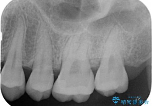 大臼歯 大きな虫歯をセラミックインレーにの治療後