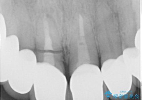 抜歯後早期インプラント埋入で術直後から噛める仮歯が入る!の治療前