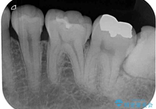 銀歯をなくしたい 全顎的なむし歯治療の治療前