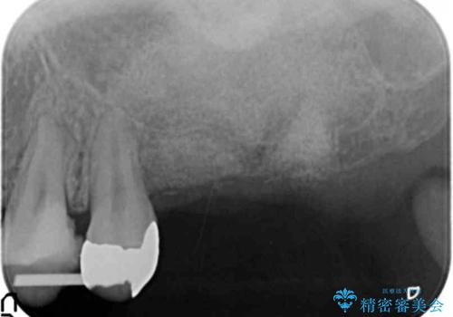 虫歯・破折の放置により重度に吸収した歯槽骨　骨造成後のインプラント治療の治療中