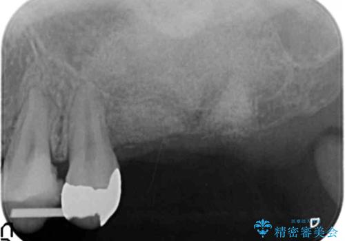虫歯・破折の放置により重度に吸収した歯槽骨 骨造成後のインプラント治療の治療中