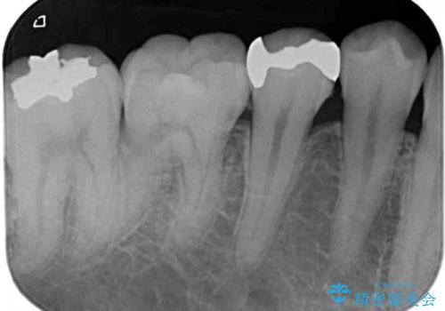 銀歯をなくしたい 全顎的なむし歯治療の治療前