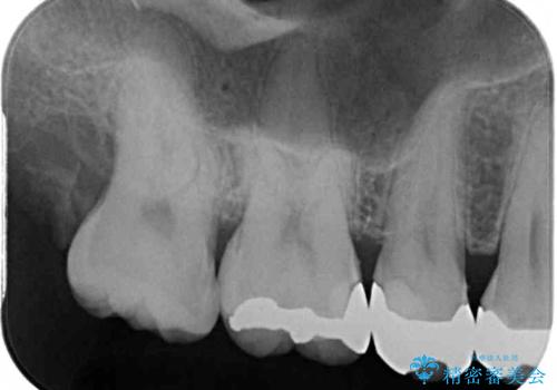 銀歯をなくしたい 全顎的なむし歯治療の治療前