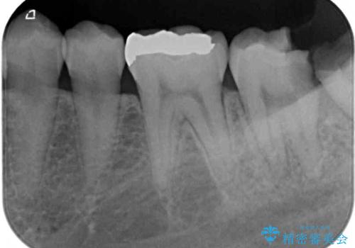 歯医者が怖い 1DAYインプラントで外科処置の恐怖を軽減の治療前
