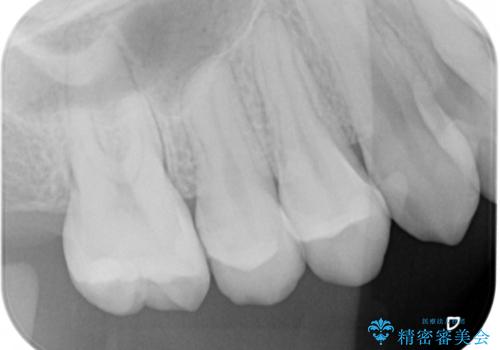 変色した詰め物の再治療 セラミックインレーの治療前