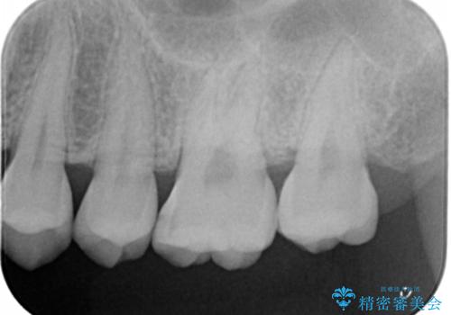 大臼歯 大きな虫歯をセラミックインレーにの治療前