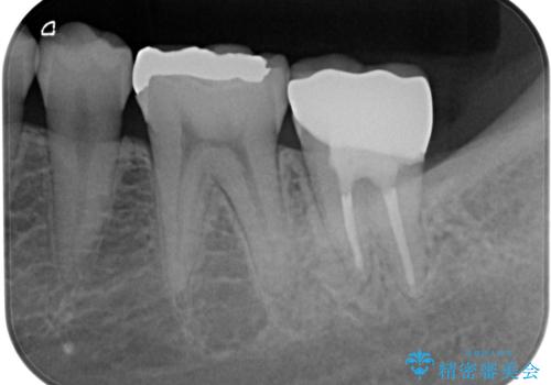 歯医者が怖い 1DAYインプラントで外科処置の恐怖を軽減の治療後