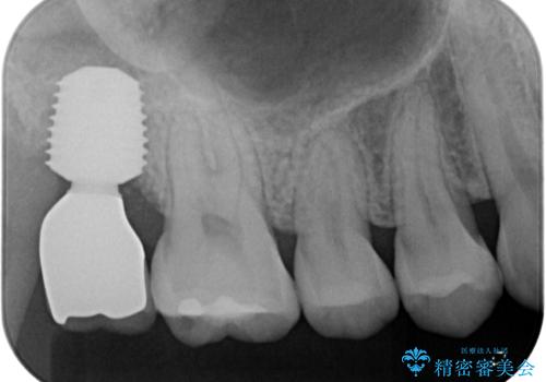 歯医者が怖い 1DAYインプラントで外科処置の恐怖を軽減の治療後