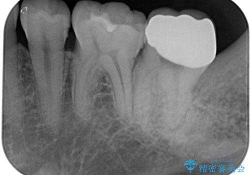 銀歯をなくしたい 全顎的なむし歯治療の治療後