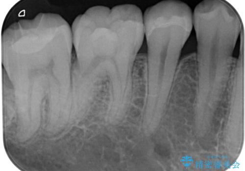 銀歯をなくしたい 全顎的なむし歯治療の治療後