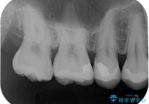 銀歯をなくしたい　全顎的なむし歯治療の治療後