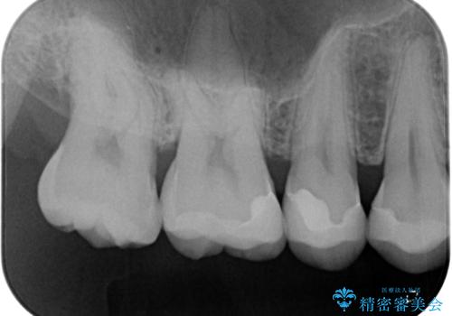 銀歯をなくしたい 全顎的なむし歯治療の治療後