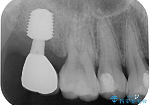放置したむし歯　抜歯後にインプラントで補綴治療の治療後