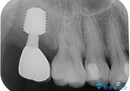 放置したむし歯 抜歯後にインプラントで補綴治療の治療後