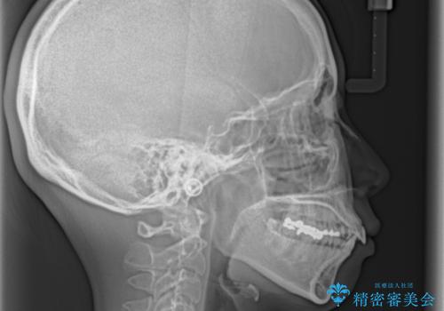 顎先に梅干し皺ができる　閉じにくい唇を抜歯矯正で閉じやすくの治療前