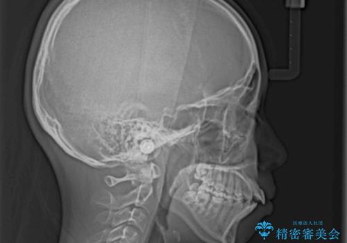 くちばしのように突出した前歯 口元を下げる抜歯矯正の治療前