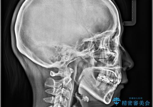顎先に梅干し皺ができる 閉じにくい唇を抜歯矯正で閉じやすくの治療後