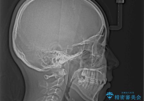 くちばしのように突出した前歯　口元を下げる抜歯矯正の治療後