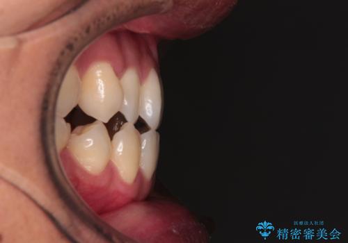 急速拡大装置 歯列弓を拡大して非抜歯ワイヤー矯正の治療前