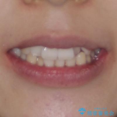 急速拡大装置 狭い歯列を拡大してワイヤー装置で短期間治療の治療前(顔貌)