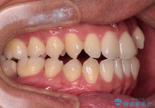 急速拡大装置 歯列弓を拡大して非抜歯ワイヤー矯正の治療前