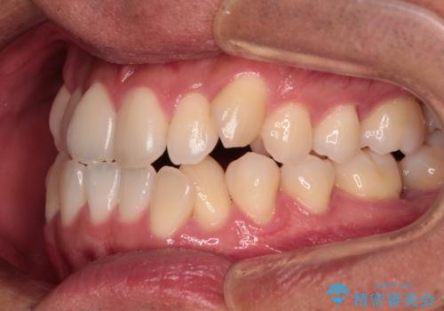 急速拡大装置 歯列弓を拡大して非抜歯ワイヤー矯正の治療前