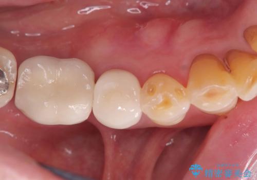 【オールセラミッククラウン】虫歯で歯が欠けた!の症例 治療後